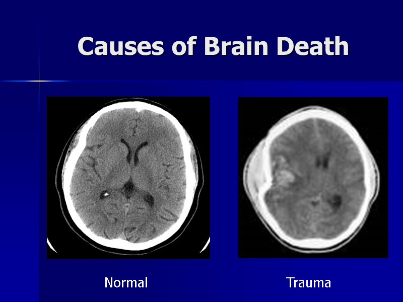 Causes of Brain Death Normal Trauma